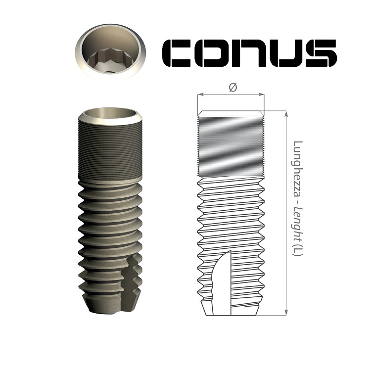 impianto dentale durata | moncone su impianto |  perno moncone costo | 
astra tech implant | 